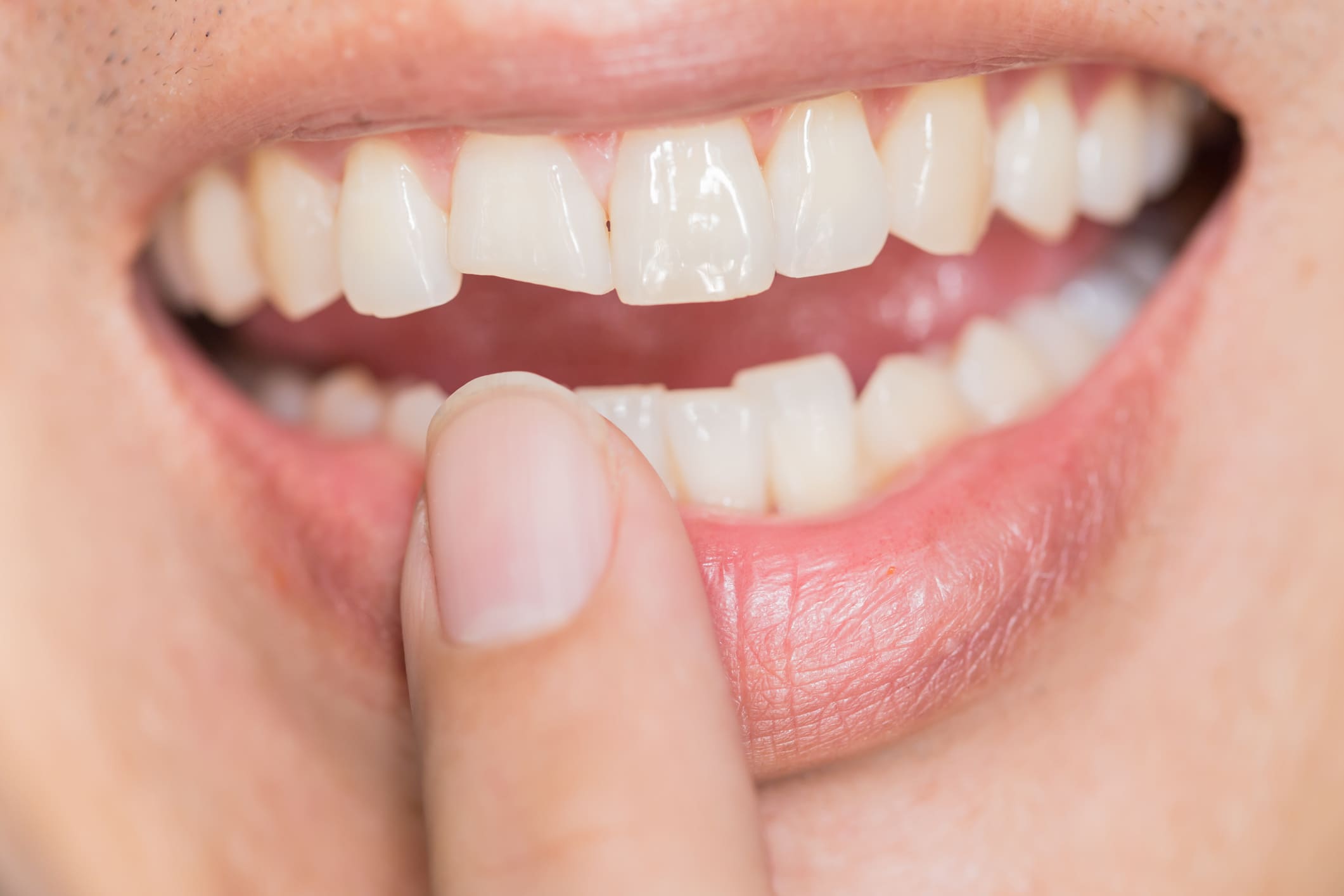 Fracturas Dentales