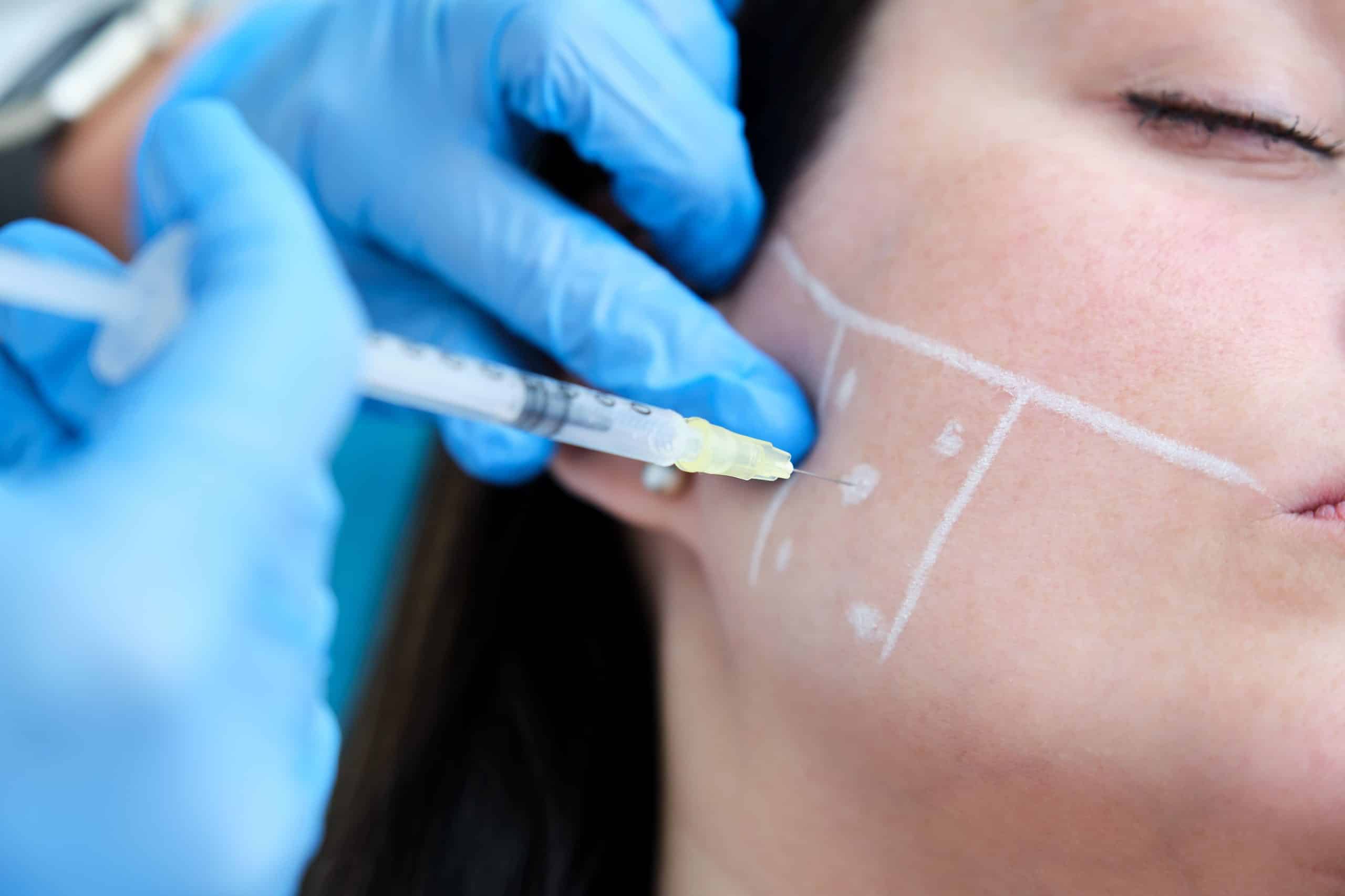 Aplicación de Botox para Bruxismo y Migrañas