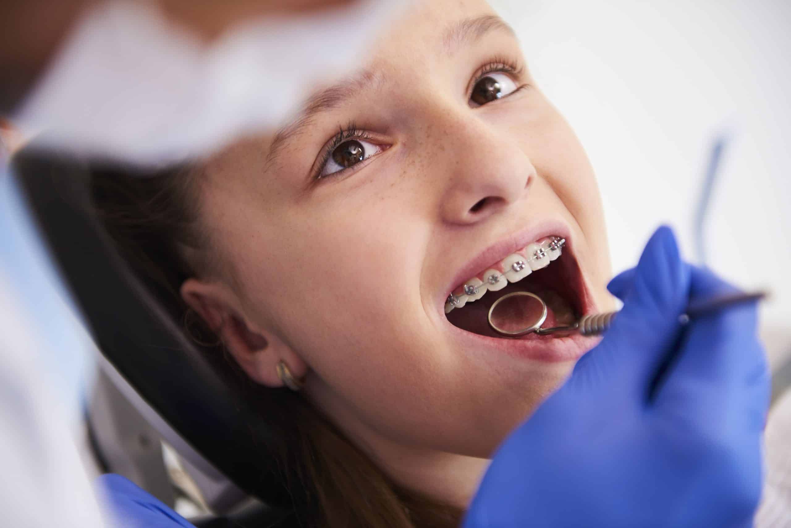 Ortodoncia con mini Brackets