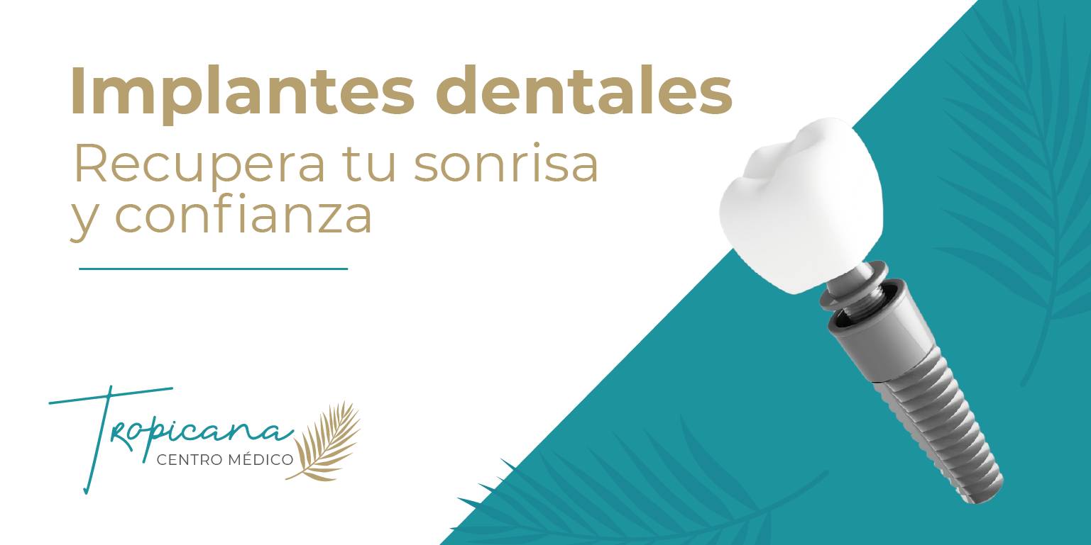 Implantes Dentales: Recupera tu Sonrisa y Confianza